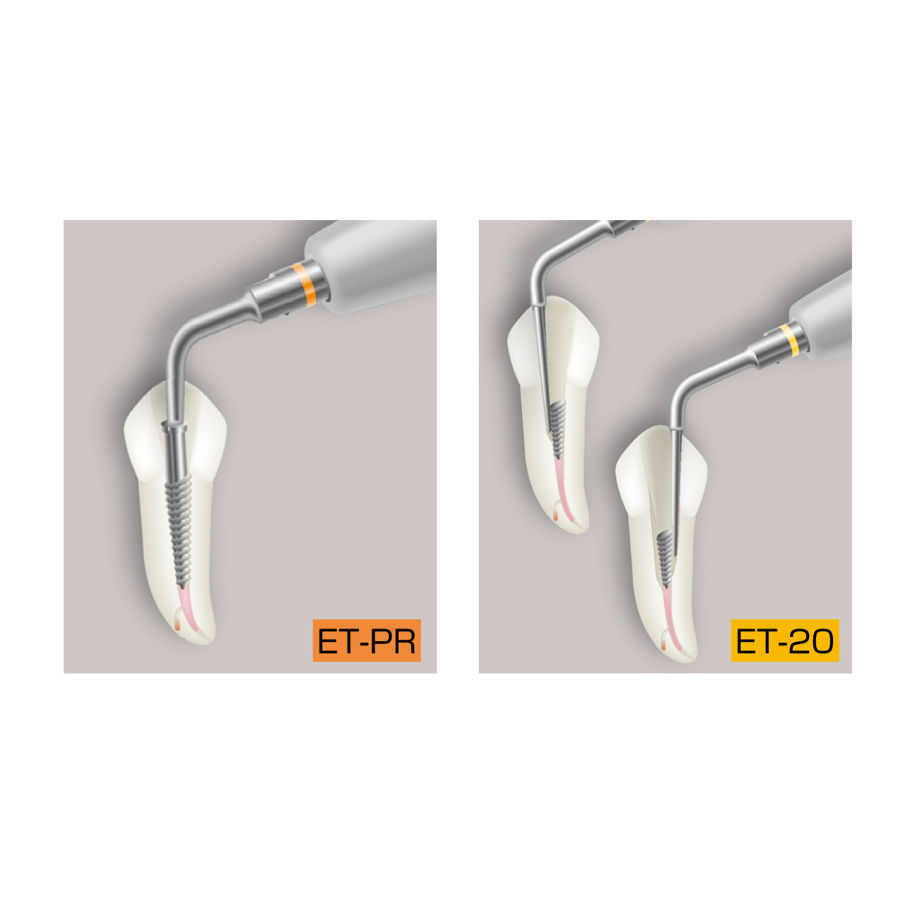 エンドサクセスチップ