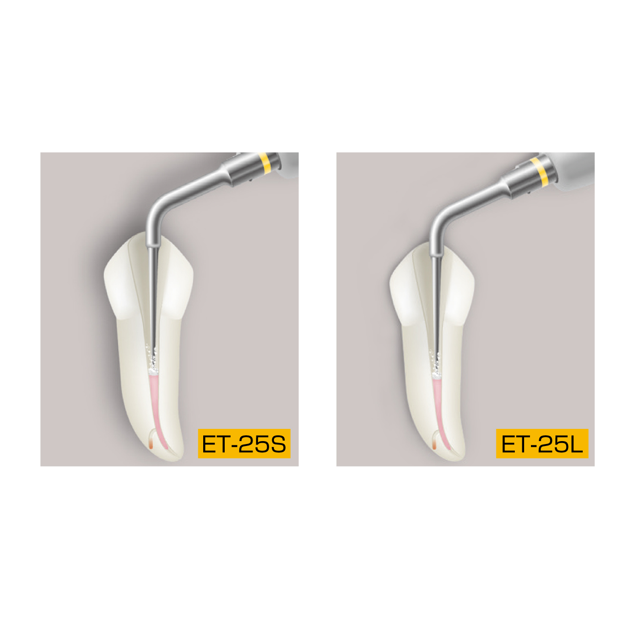 エンドサクセスチップ