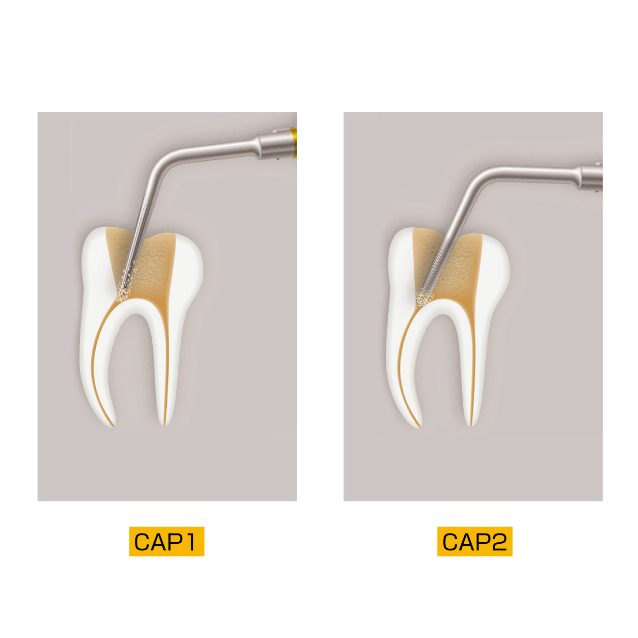 エンドサクセス キャナル アクセスチップ