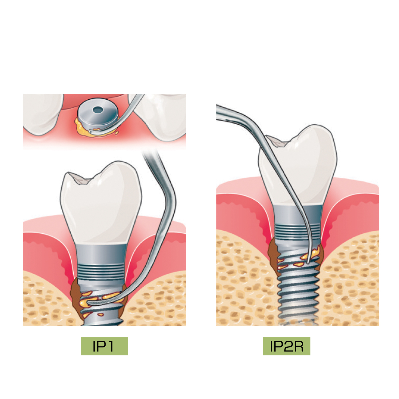 純チタンチップ(インプラントプロテクト)