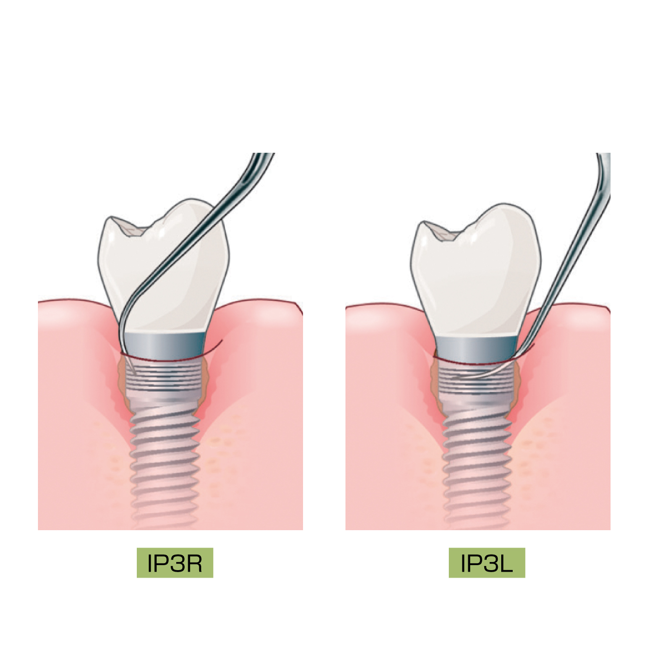純チタンチップ(インプラントプロテクト)